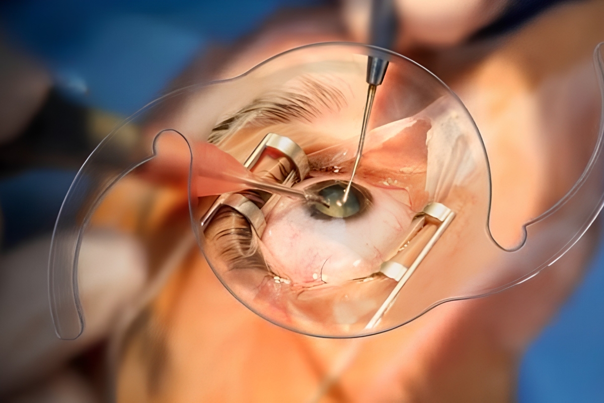 Cataract Surgery