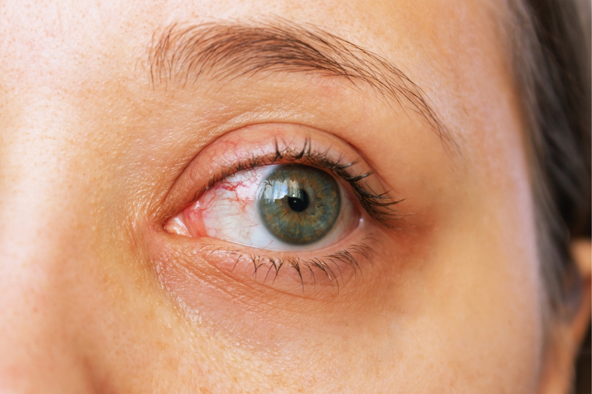 Dry Eye & Contact Lens